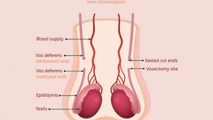 Seven Things You Should Know About Vasectomy